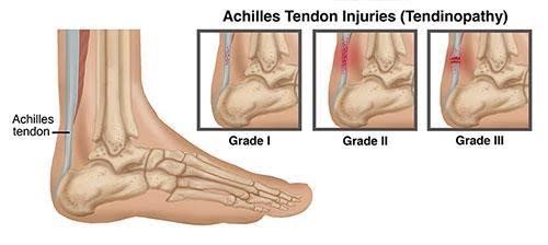 achilles tendon and calf pain